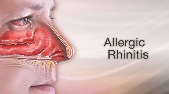 Mengenal Rhinitis